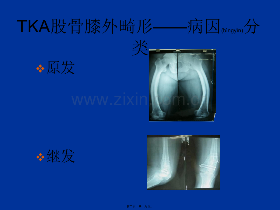 股骨侧膝外畸形的人工全膝关节置换术概要.ppt_第2页