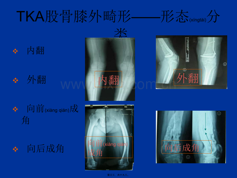 股骨侧膝外畸形的人工全膝关节置换术概要.ppt_第3页