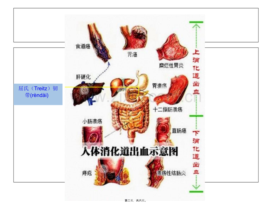 学术讨论—上下消化道出血鉴别.ppt_第2页