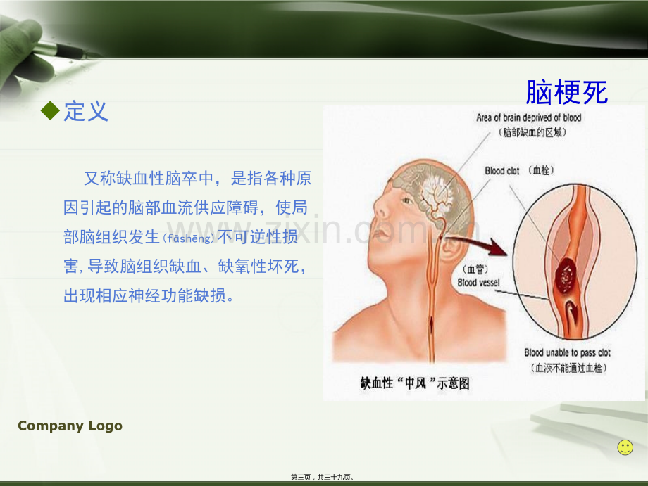 学术讨论—脑梗死诊治规范.ppt_第3页