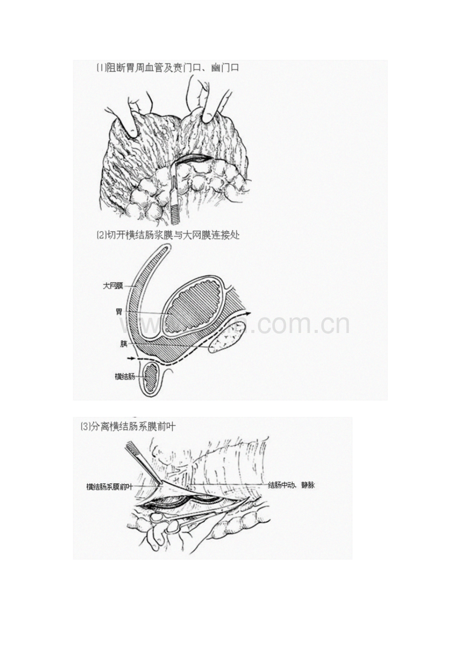 胃癌根治术全过程图解及手术常识.docx_第2页