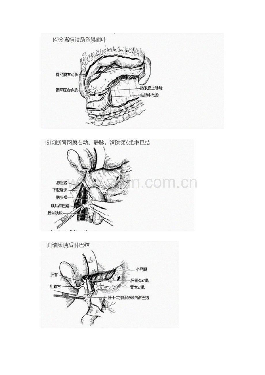 胃癌根治术全过程图解及手术常识.docx_第3页