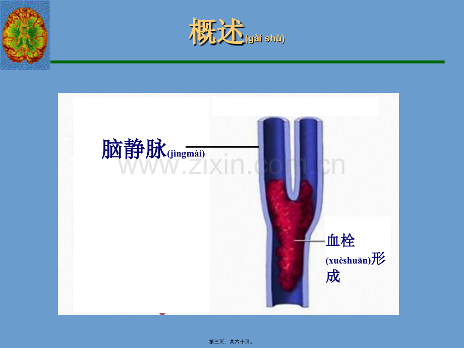 脑静脉系统血栓形成全面PPT概要.ppt_第3页