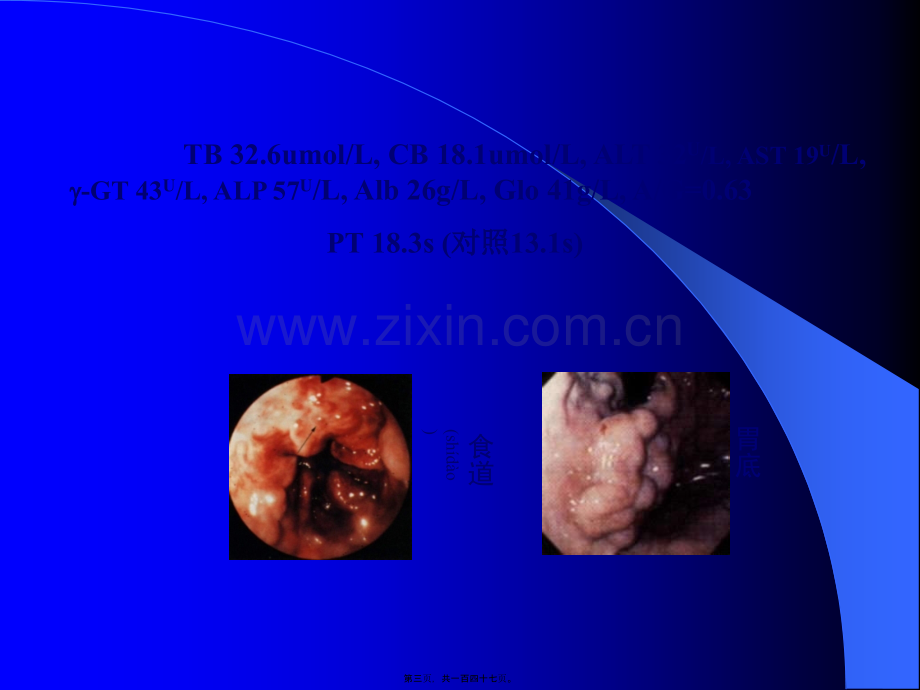 肝硬化教学PPT.ppt_第3页