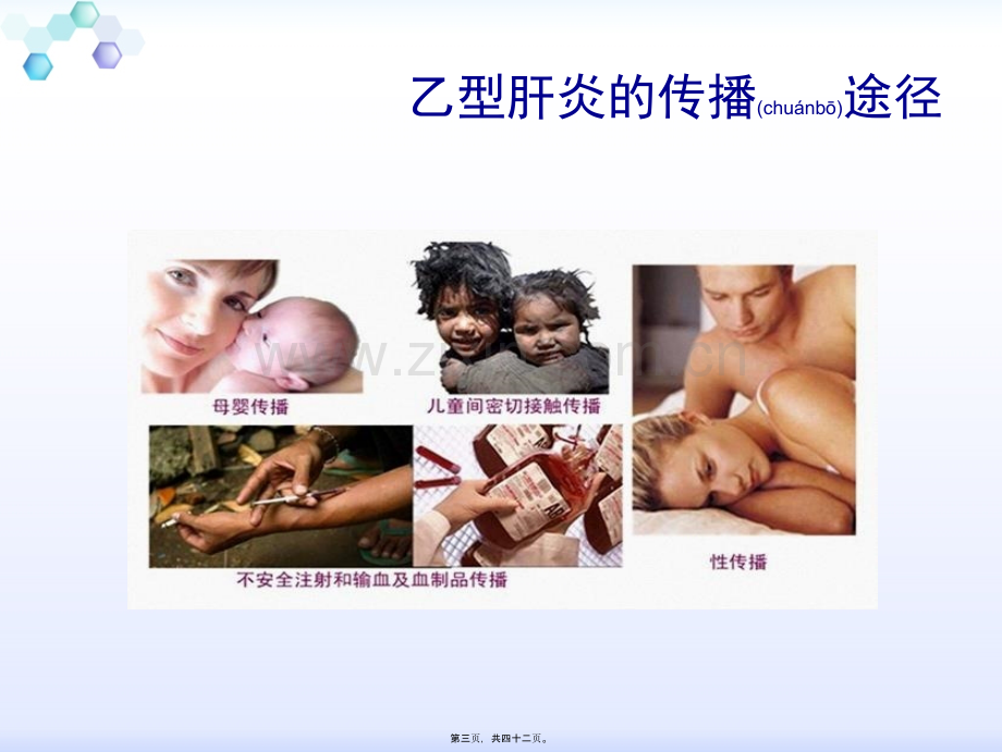 学术讨论—乙型肝炎的母婴传播.ppt_第3页