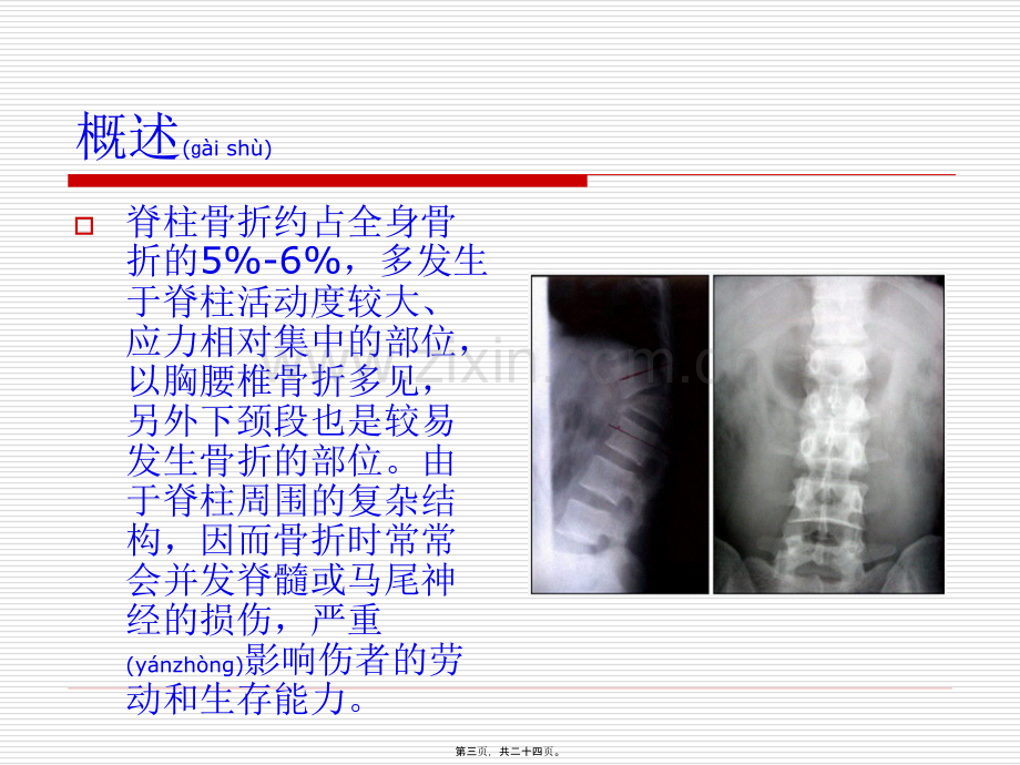 脊柱骨折康复.ppt_第3页