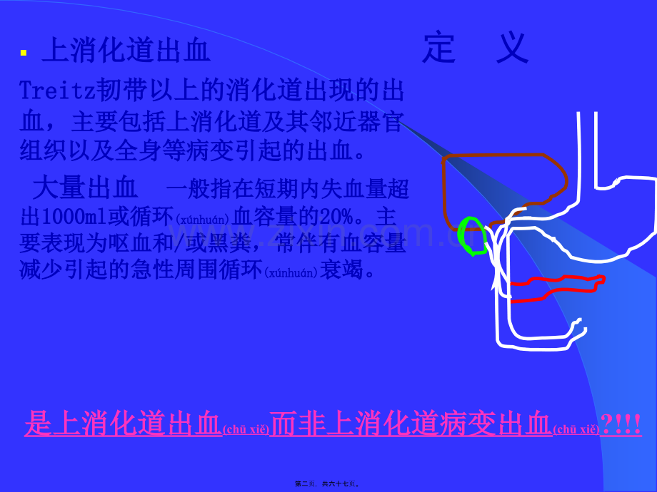 上消化道出血的处理(武希润).ppt_第2页