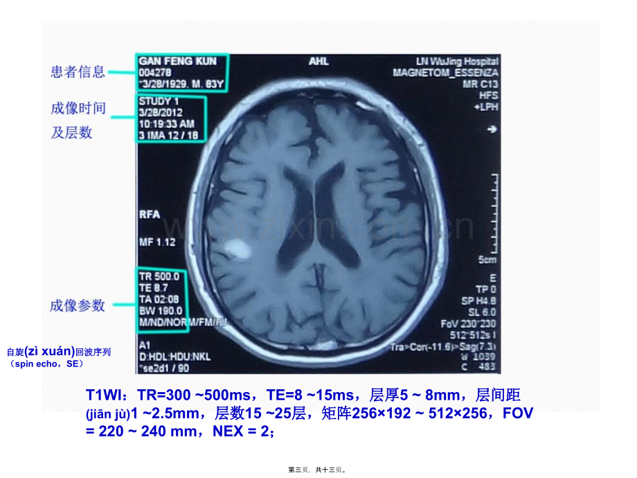 脑出血和脑梗塞的MRI.ppt_第3页