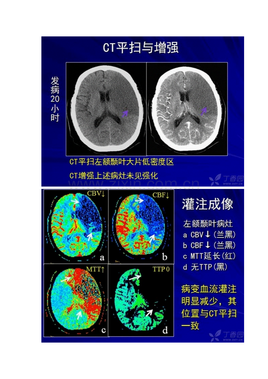 脑缺血CT灌注基础知识.docx_第3页