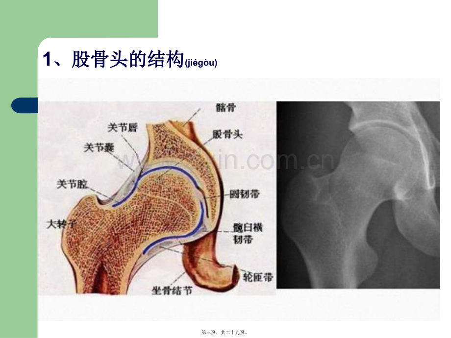 股骨头坏死(1)研究.ppt_第3页