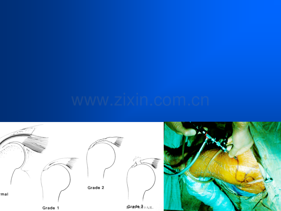 肩关节损伤MRI.ppt_第1页