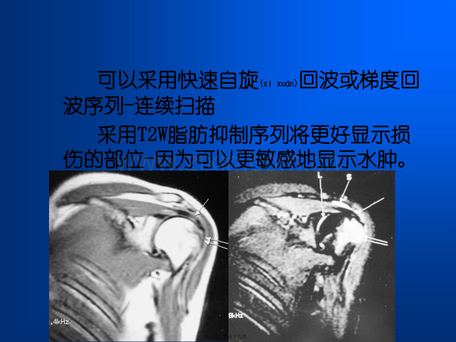 肩关节损伤MRI.ppt_第3页