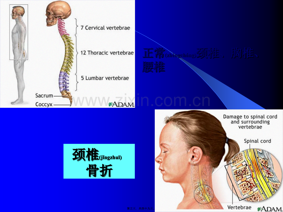 学术讨论—脊柱骨折与脊髓损伤.ppt_第3页