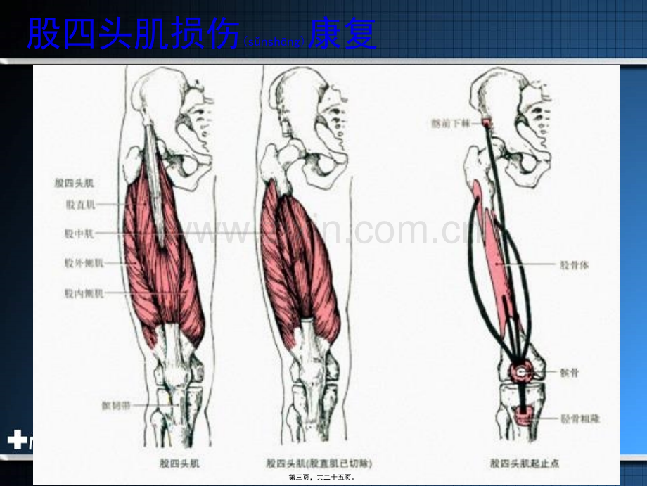 学术讨论—肌腱损伤后康复.ppt_第3页