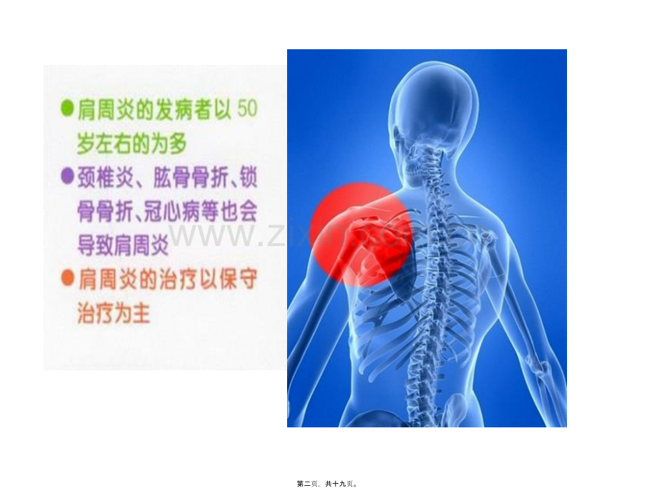 肩周炎的防治及功能锻炼.ppt_第2页