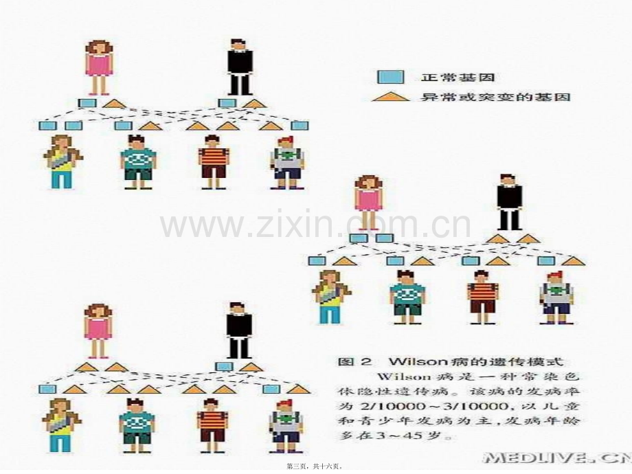 肝豆状核变性.ppt_第3页