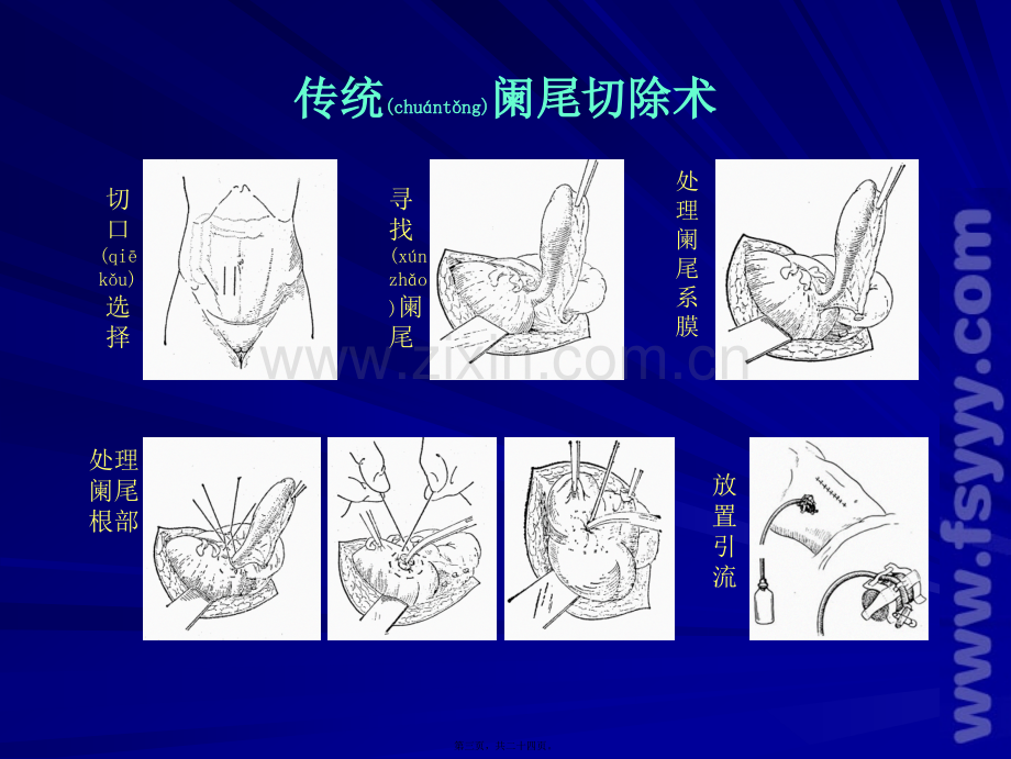 腹腔镜阑尾切、胃穿孔修补.ppt_第3页