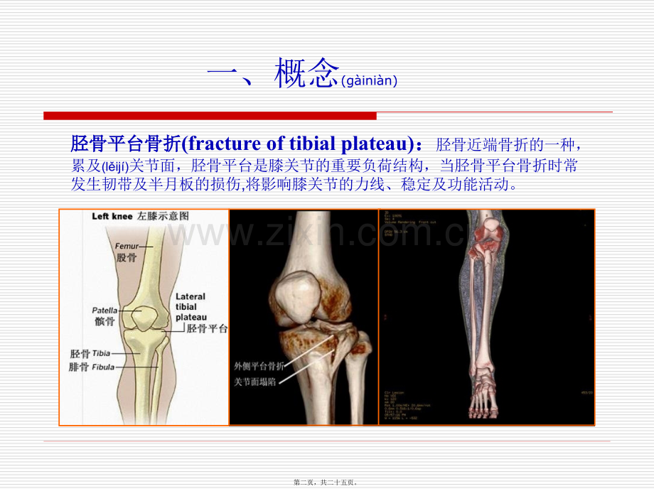 胫骨平台骨折fractureoftibialplateau.ppt_第2页