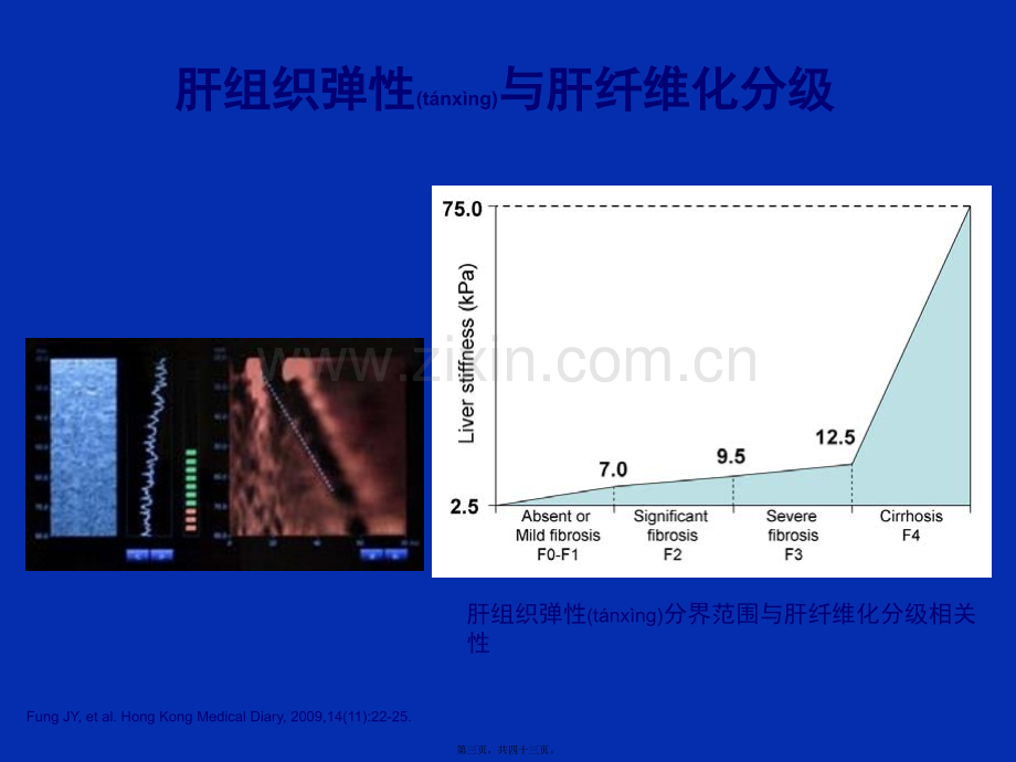 乙肝肝硬化并发症的处理.ppt_第3页