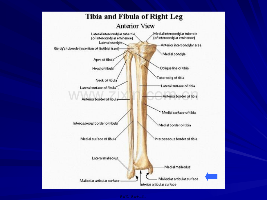 胫骨平台骨折胫腓骨骨干骨折.ppt_第3页