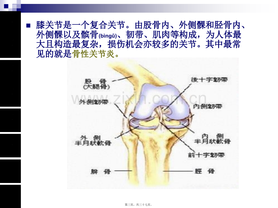 人工膝关节置换术手术配合ppt..ppt_第3页