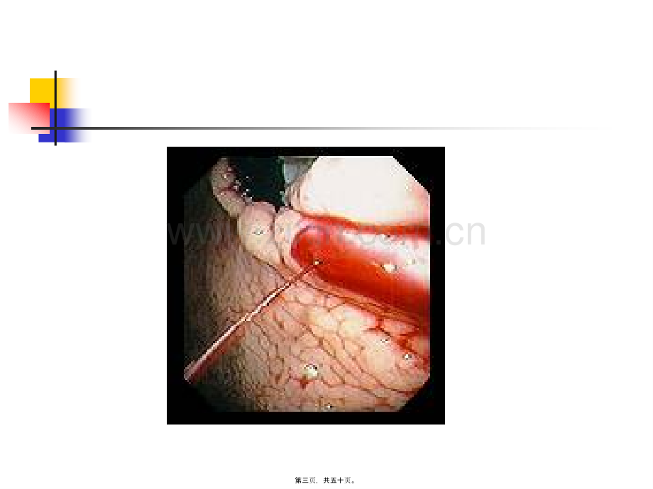 上消化道出血--wangjuan.ppt_第3页