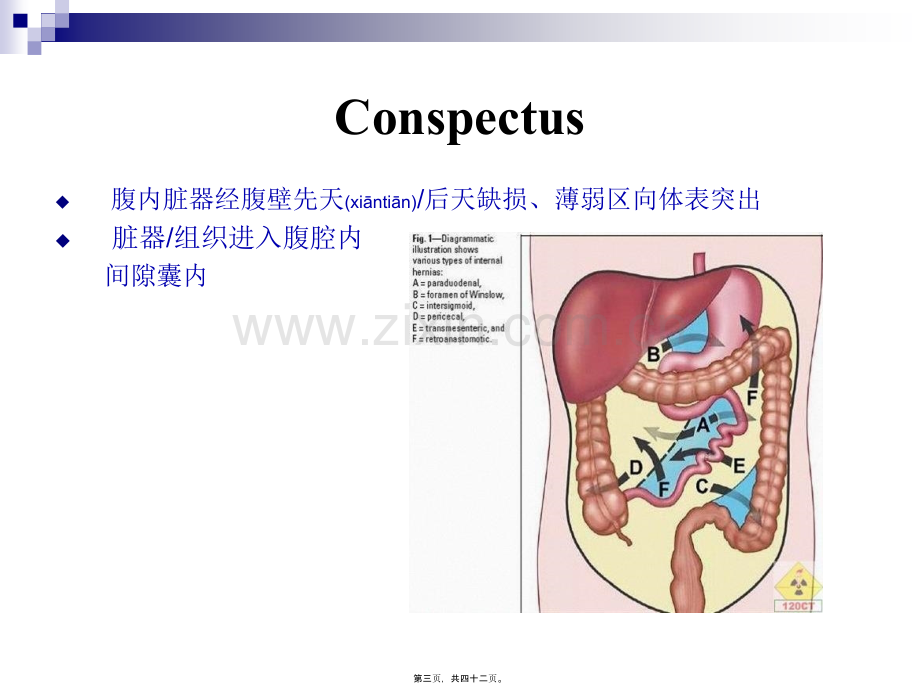 腹外疝(上网版).ppt_第3页