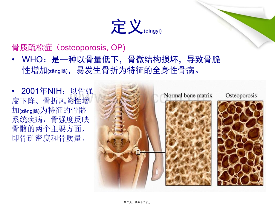 老年科-原发性骨质疏松症诊治指南.ppt_第2页