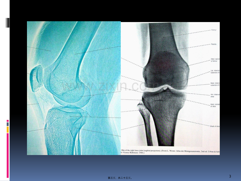 学术讨论—膝关节功能康复.pptx_第3页