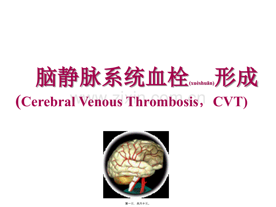 学术讨论—脑静脉系统血栓形成.简介.ppt_第1页