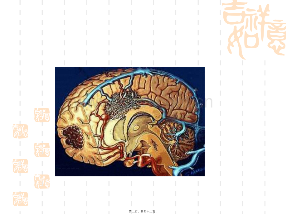 脑血栓.ppt_第2页