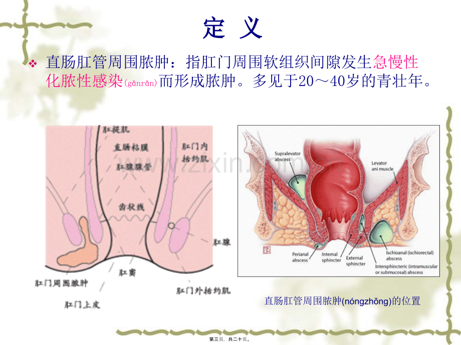 肛周脓肿ppt.ppt_第3页