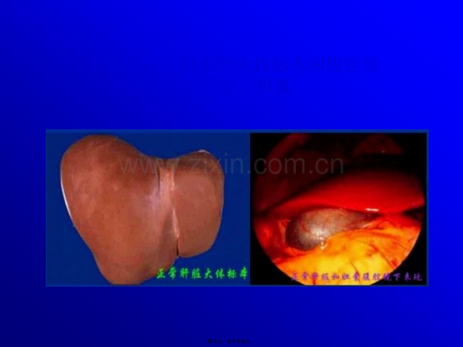 学术讨论—肝衰--2011122.ppt_第3页