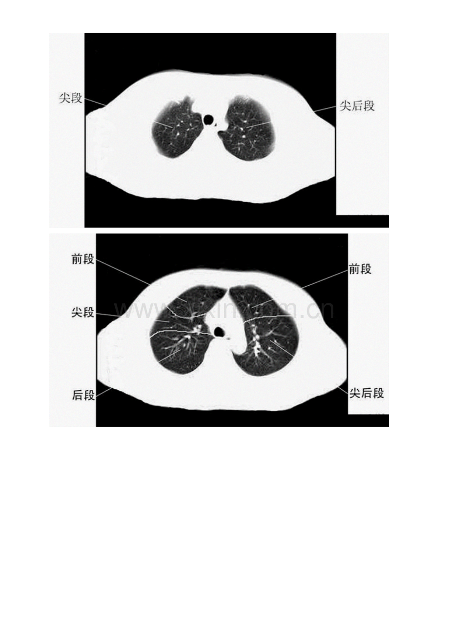 胸部CT肺段划分口诀.doc_第2页