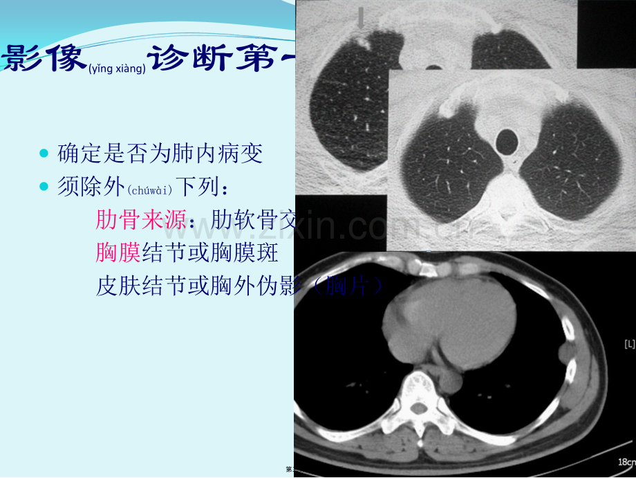 胸部CT肺内孤立性结节.ppt_第3页