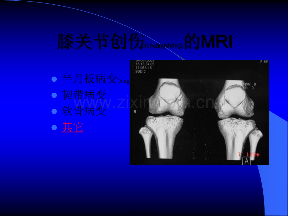 MRI在膝关节创伤的应用.ppt_第2页