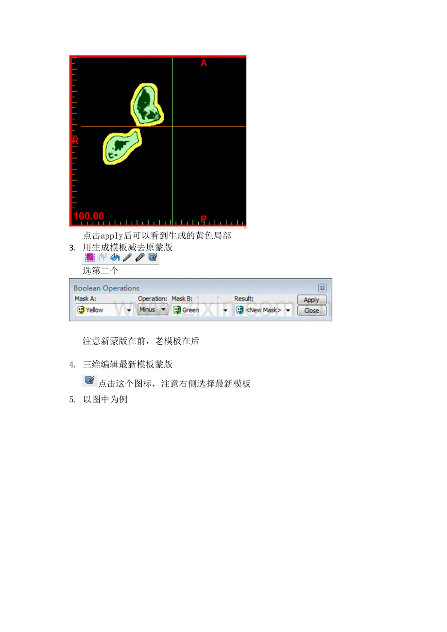 学术讨论—mimics手术导板制作-简单易行.doc_第2页