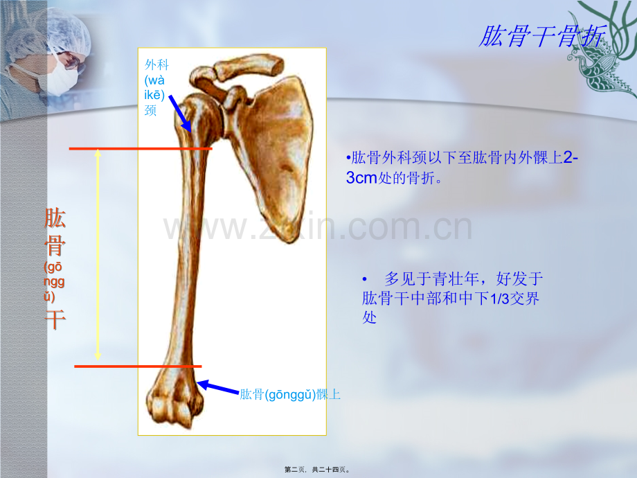 肱骨干骨折.ppt_第2页