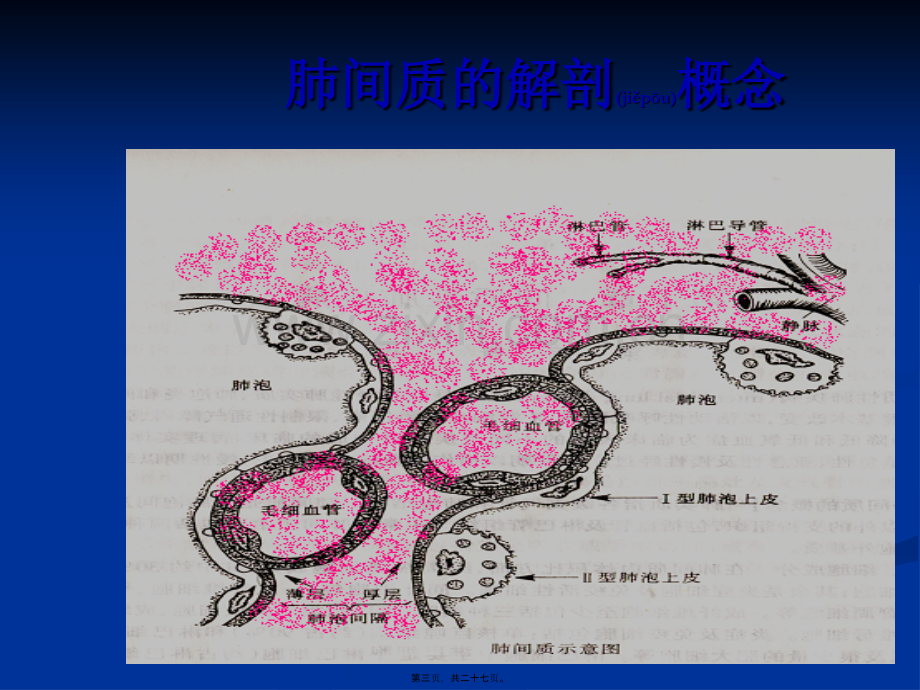 -特发性肺纤维化.ppt_第3页