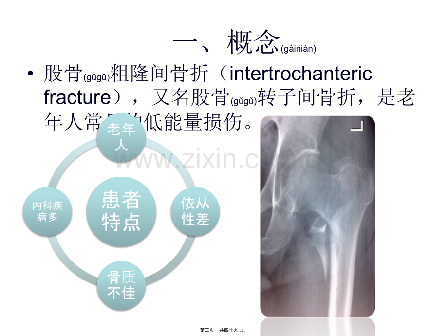 PFNA在股骨粗隆间骨折的应用.ppt_第3页