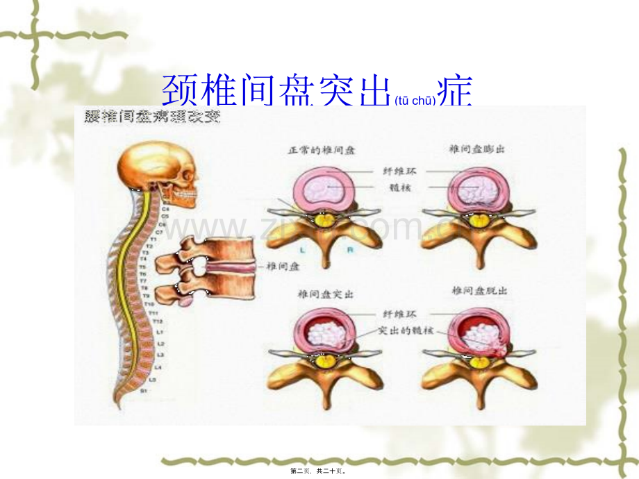 等离子消融术围手.ppt_第2页