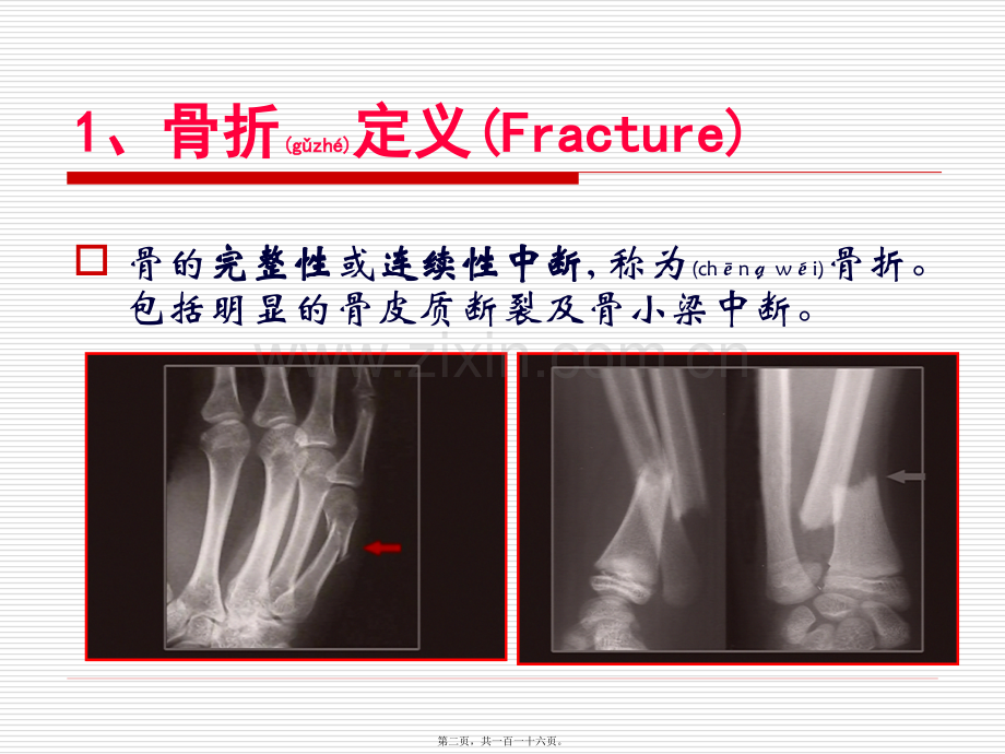 第六章-骨折概论.ppt_第2页