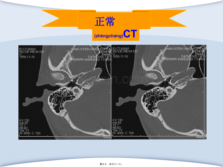 第八讲-中耳炎.ppt_第3页