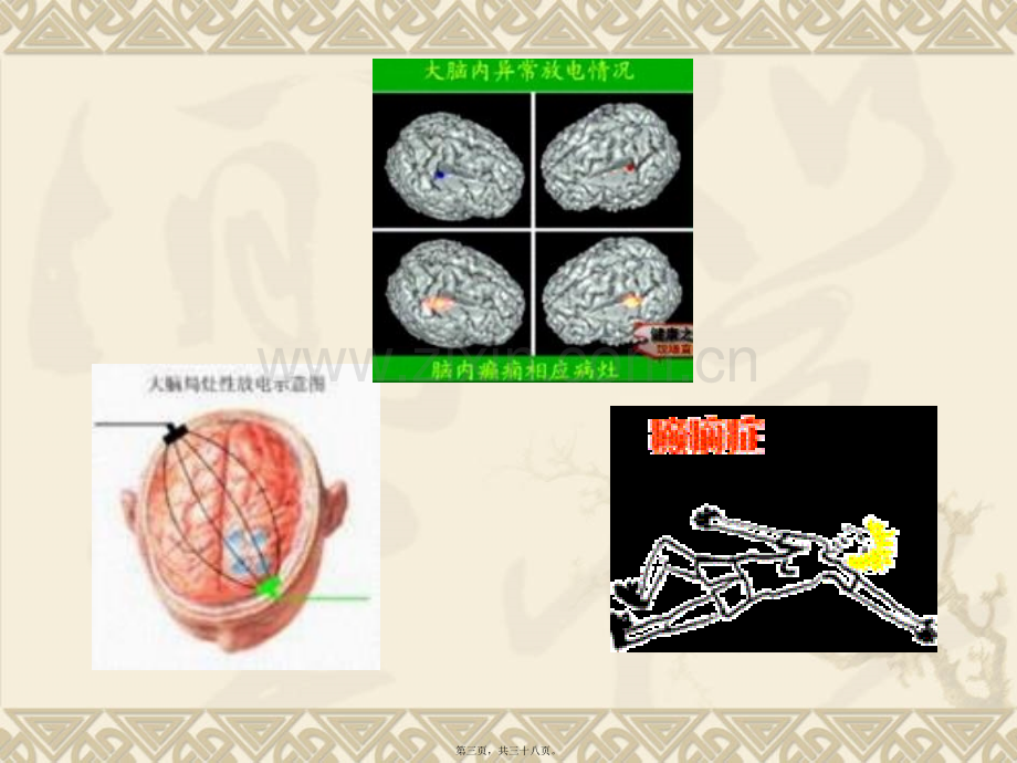 学术讨论—第十四章-抗癫痫药和抗惊厥药.ppt_第3页