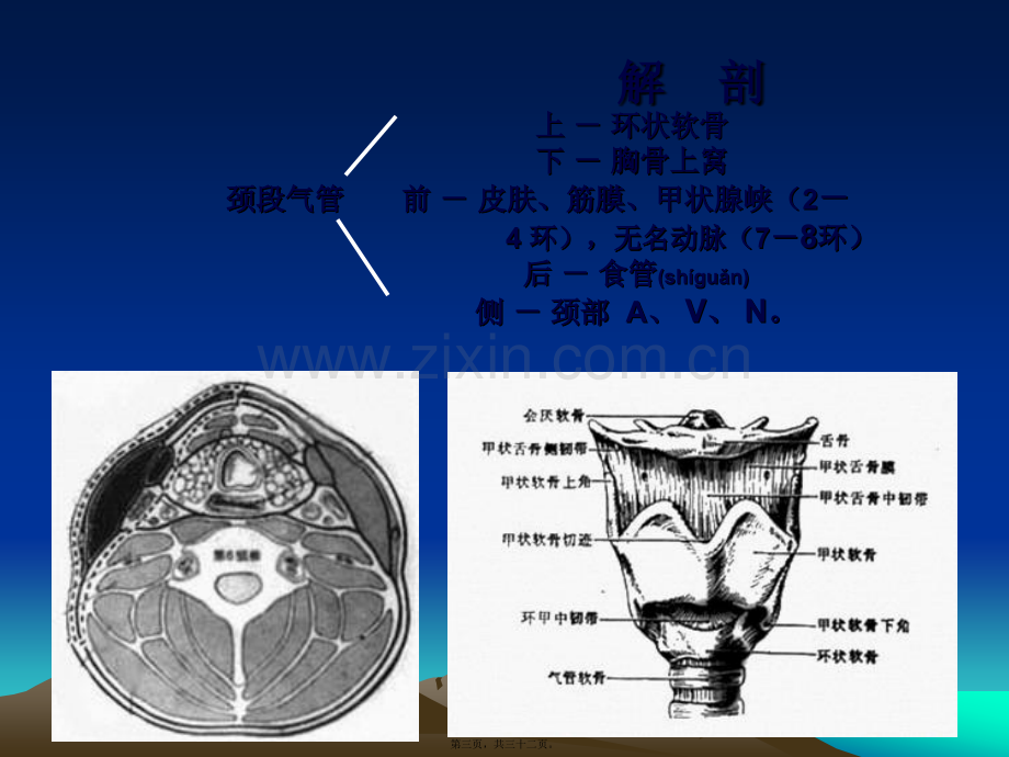 经皮式气管切开术.ppt_第3页