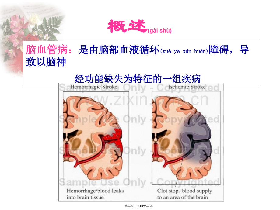 缺血性脑血管病-脑梗塞.ppt_第2页