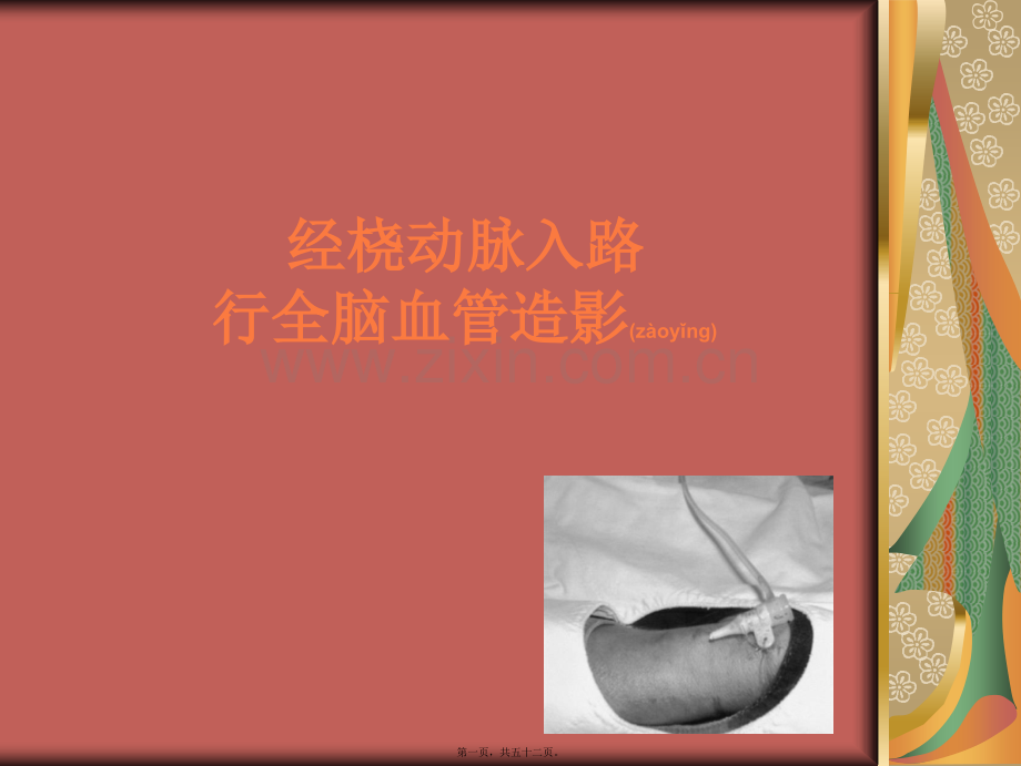 经桡动脉DSA.ppt_第1页