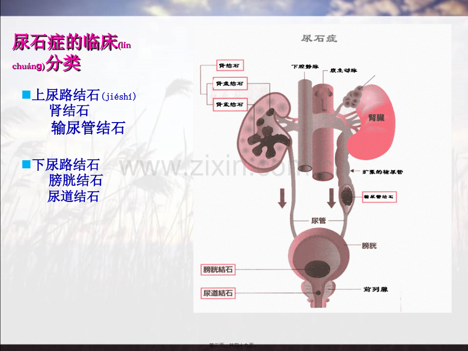 结石医患沟通.ppt_第3页