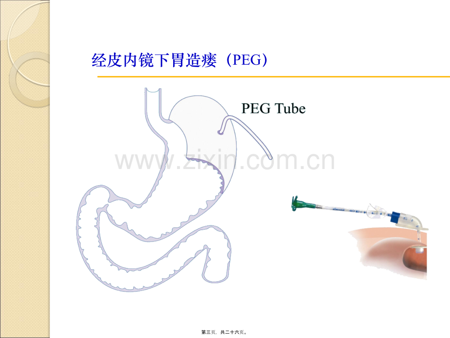 经皮内窥镜引导下胃造口管.ppt_第3页