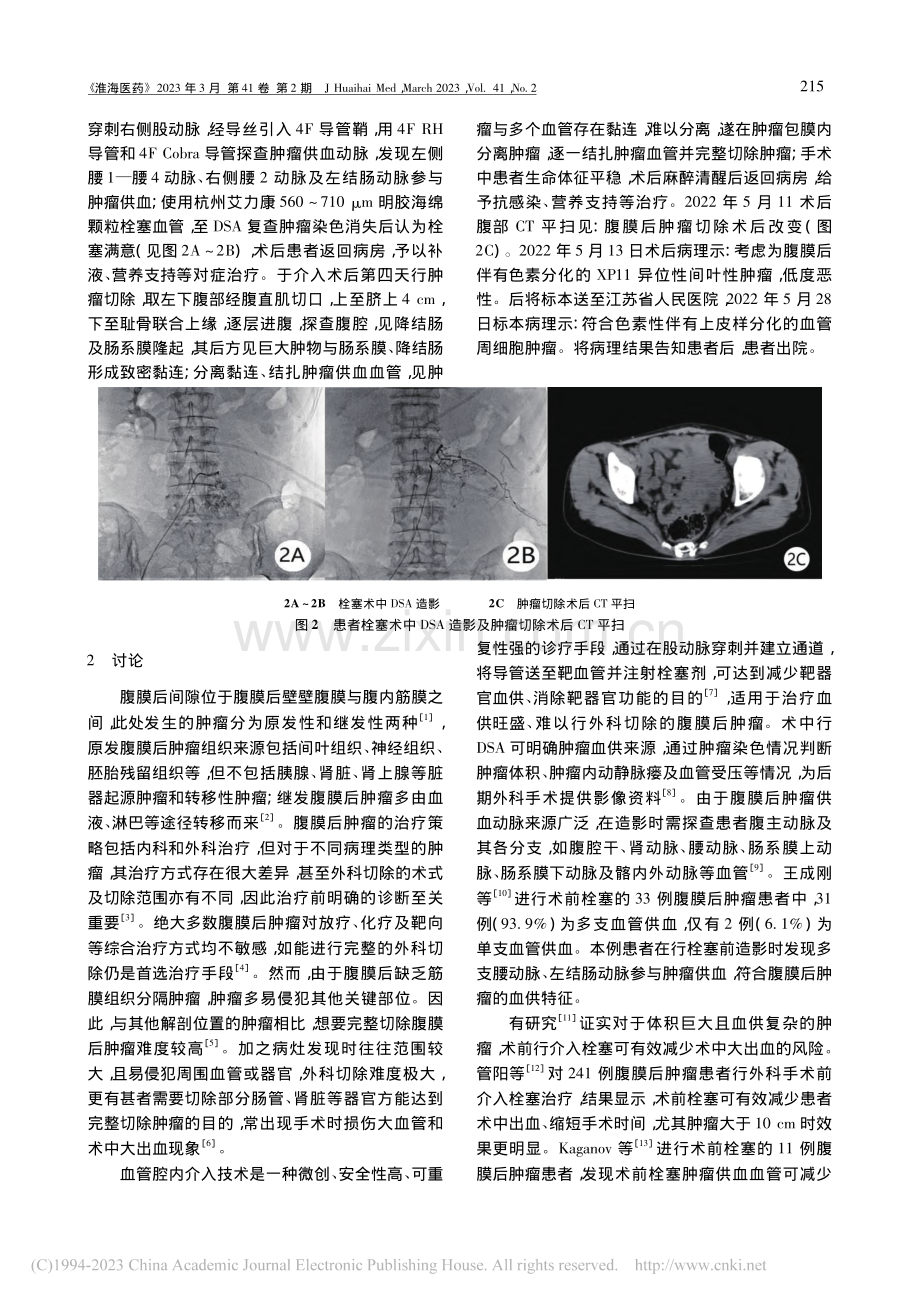 介入栓塞联合外科切除治疗原发腹膜后肿瘤1例_徐士伟.pdf_第2页